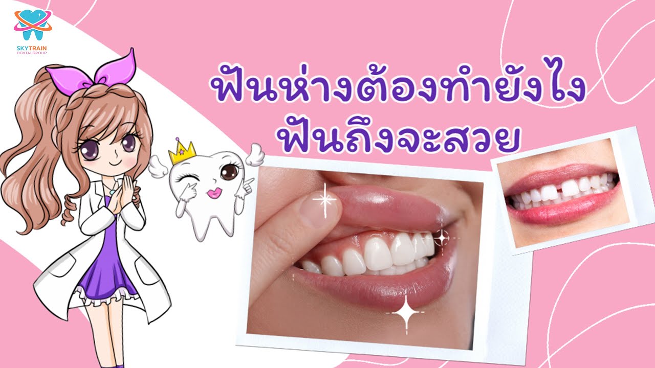 ฟันห่างต้องทำยังไงฟันถึงจะสวย | Skytrain Dental