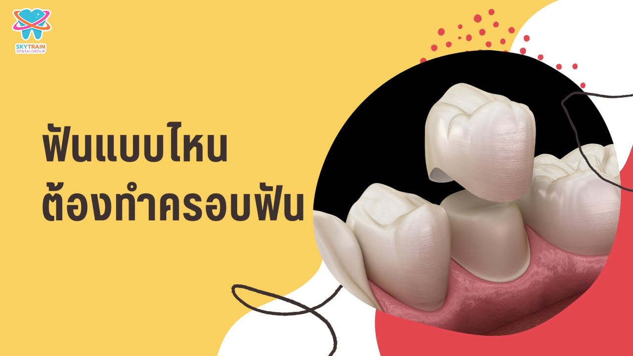 ฟันแบบไหนต้องทำครอบฟัน และครอบฟันมีกี่แบบ มีขั้นตอนการทำยังไง | Skytrain Dental