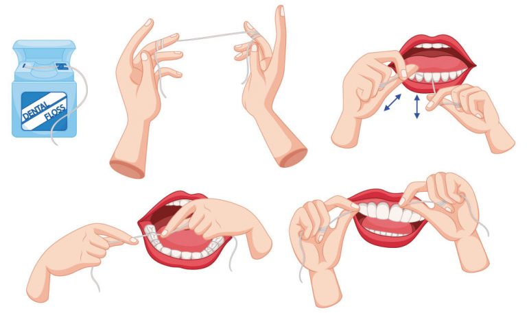 Using Superfloss for braces