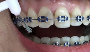 How to use a tooth brush for orthodontics