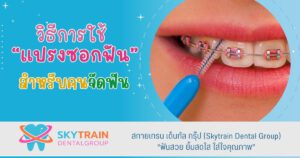 วิธีการใช้แปรงซอกฟัน สำหรับคนจัดฟัน