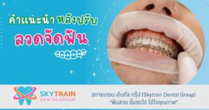 คำแนะนำหลังปรับลวดจัดฟัน