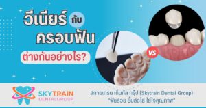 [ไขข้อสงสัย] วีเนียร์กับครอบฟันต่างกันอย่างไร