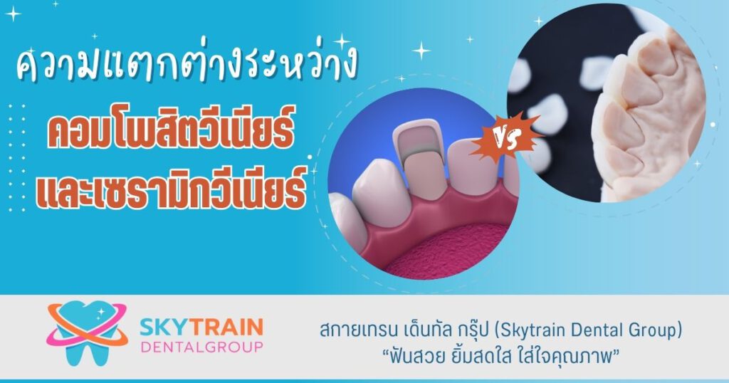 ความแตกต่างระหว่างคอมโพสิตวีเนียร์ และเซรามิกวีเนียร์