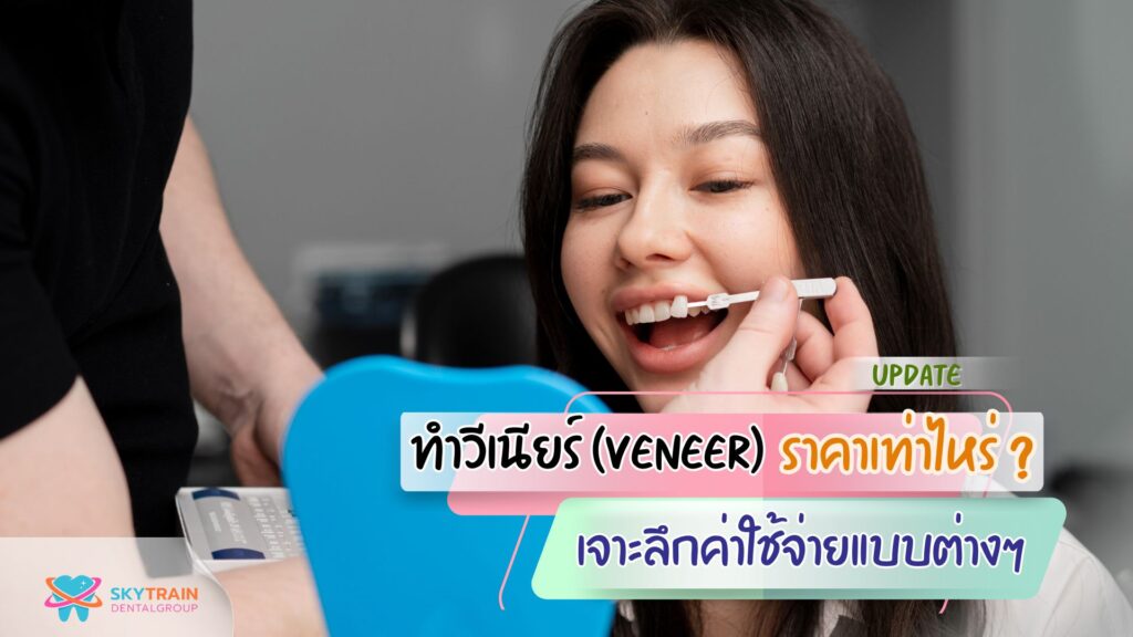[อัปเดต 2026] ทำวีเนียร์ ราคาเท่าไหร่ ? เจาะลึกค่าใช้จ่าย แบบต่างๆ