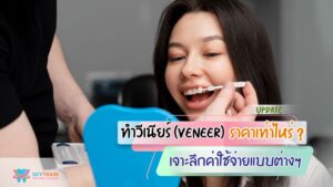 [อัปเดต 2026] ทำวีเนียร์ ราคาเท่าไหร่ ? เจาะลึกค่าใช้จ่าย แบบต่างๆ