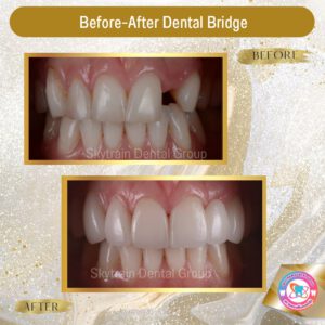 Dental Bridge (2)