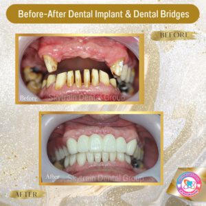 Dental Bridge (7)