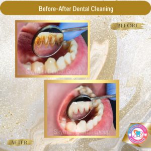 Dental Cleaning (2)