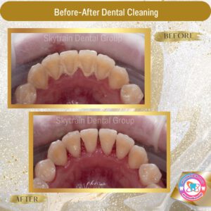 Dental Cleaning (4)