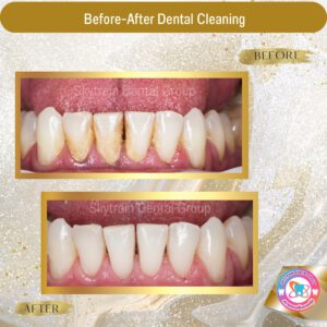 Dental Cleaning (5)