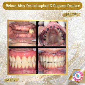 Dental Implant (1)