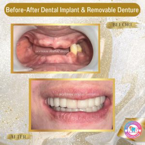 Dental Implant (3)