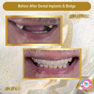 Dental Implant (5)
