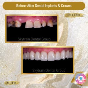 Dental Implant (6)