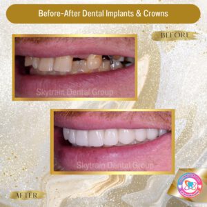 Dental Implant (7)