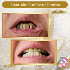 Gum Treatment (1)