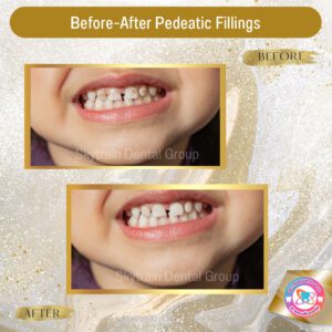 Pedodontic Treatment (1)