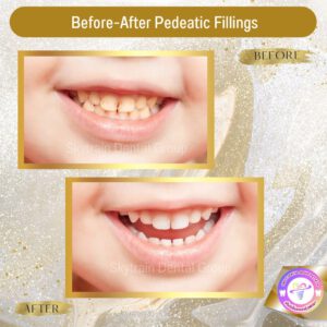 Pedodontic Treatment (2)
