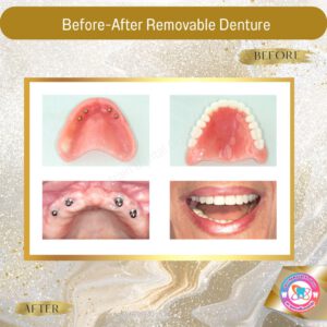 Removable Denture (11)