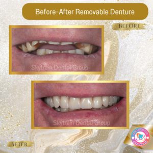 Removable Denture (8)
