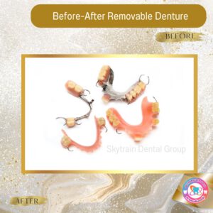 Removable Denture (9)