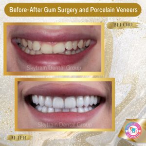 cosmetic-gum-surgery (1)