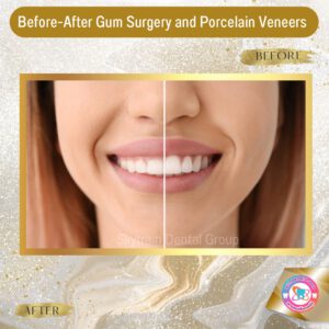 cosmetic-gum-surgery (2)