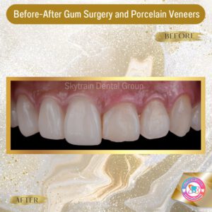 cosmetic-gum-surgery (3)