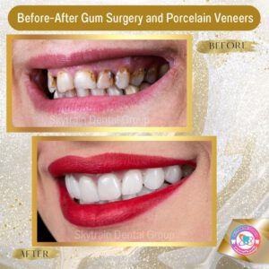 cosmetic-gum-surgery (4)