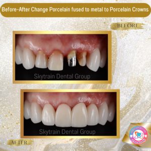 dental crown (16)