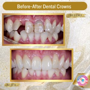 dental crown (19)