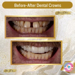 dental crown (21)