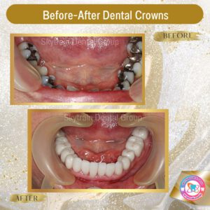dental crown (22)
