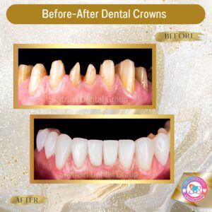 dental crown (23)