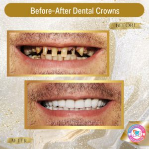 dental crown (24)
