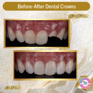 dental crown (25)
