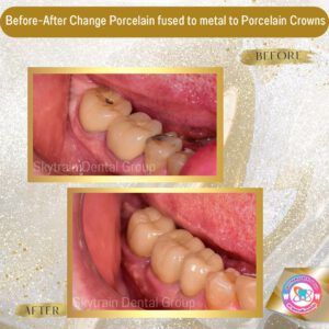 dental crown (7)