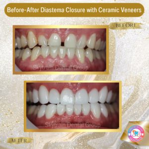 dental-veneer (14)