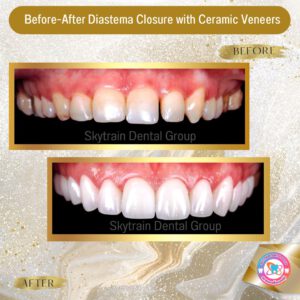 dental-veneer (16)