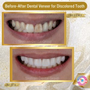 dental-veneer (2)