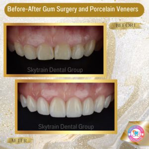 dental-veneer (4)