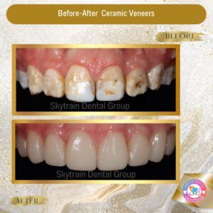 dental-veneer (6)