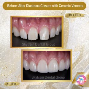 diastema-closure (3)