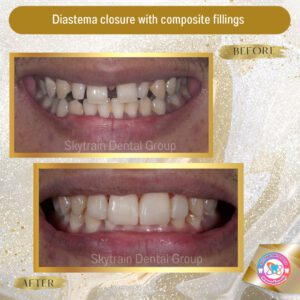 diastema-closure (7)