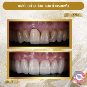 ครอบฟัน (12)