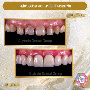 ครอบฟัน (15)