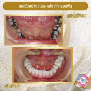 ครอบฟัน (16)