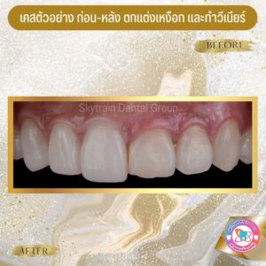 ตกแต่งเหงือกเพื่อความสวยงาม (10)