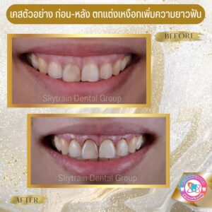 ตกแต่งเหงือกเพื่อความสวยงาม (5)
